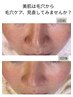 毛穴撃退 3回集中コース｜お顔全体の毛穴に集中