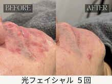 スキンジム(SKIN GYM)/月1~2施術×専用化粧水毎日使用