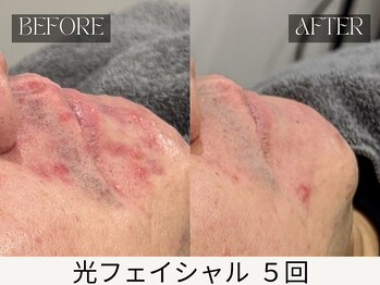 スキンジム(SKIN GYM)/月1~2施術×専用化粧水毎日使用