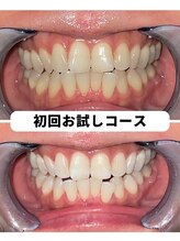 ホワイトニングビューティー 吉祥寺店/ホワイトニング　初来店