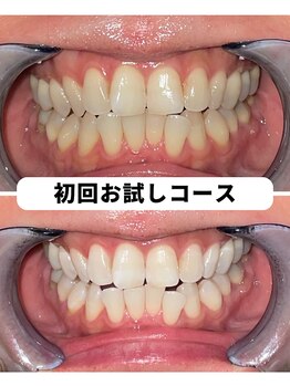 ホワイトニングビューティー 吉祥寺店/ホワイトニング 初来店