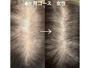 いいとこ鍼灸院の写真/抜け毛/細毛/前髪の後退など髪のお悩みに◎凄腕鍼灸師による育毛促進鍼コース◇60分￥22000→￥5500