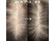 いいとこ鍼灸院の写真/抜け毛/細毛/前髪の後退など髪のお悩みに◎凄腕鍼灸師による育毛促進鍼コース◇60分￥22000→￥5500