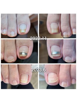 巻いた爪・丸まった爪