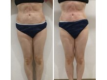 レミュー/全身ダイエット3回目症例