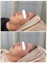 エムイーボーテ(me.Beaute)/むくみ改善、小顔効果もアリ！