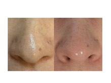 イロドリ(irodori)/毛穴ケア♪ツルツルお鼻♪