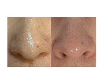 イロドリ(irodori)/毛穴ケア♪ツルツルお鼻♪