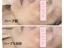 肌育【ハーブピーリング】は広範囲のシミや定着したくすみにも◎