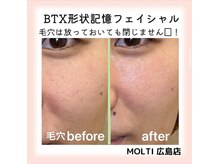 モルティー 広島店(Molti)/毛穴は放っておいても閉じません