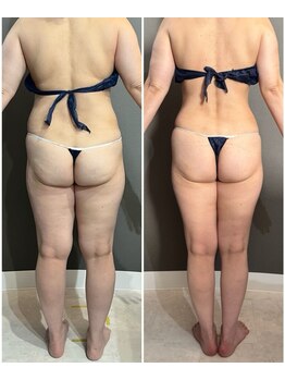 エミニー バイ エルズ(Eminy by L★s)/50代 セルゼロ全身 27回