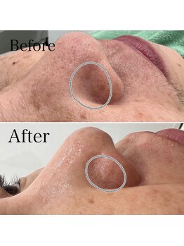 グランド ビューティー ビーズ 半田店(Grand Beauty B's)/毛穴ケア