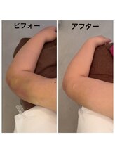 リボーテ(Re-Beaute)/インディバ 拘縮ケア