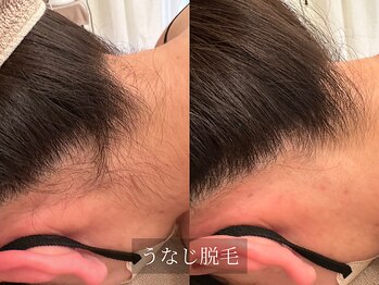 アルム(Arum)/うなじ脱毛