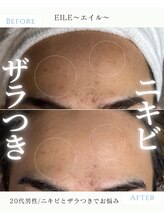 エイル(EILE)/症例1