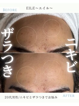 エイル(EILE)/症例1