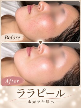 フルールドリス(FLEUR DE LIS)の写真/【シミ/しわ/くすみ】韓国ララピールで透明感アップ！すでに出来てしまったシミしわにも◎
