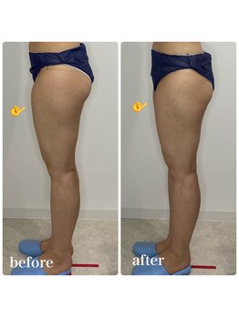 カプリス(CAPRiCE)/リンパドレナージュ