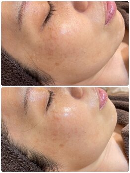 シェービングルームエスプリ(esprit)/剥離なし次世代ハーブピーリング