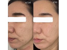 アネラ 難波(ANERA)/30代女性 肌質改善/ほうれい線