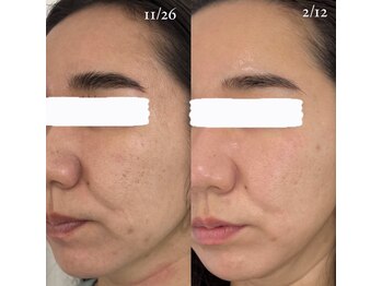 アネラ 難波(ANERA)/30代女性 肌質改善/ほうれい線