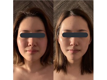 ハイコガオ 中崎町店(HIKOGAO)/小顔矯正7回