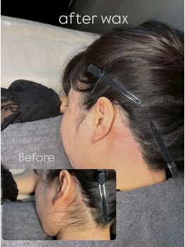 ビオトーン バイ ツリー(biotone by TREE)/うなじ/Wax脱毛/ワックス脱毛