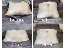 ムート(Mut.)/メンズ脱毛／VIO