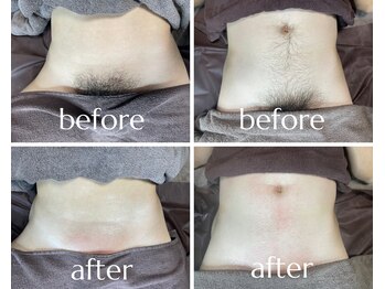 ムート(Mut.)/メンズ脱毛／VIO