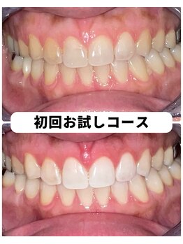 ホワイトニングビューティー 吉祥寺店/ホワイトニング 初来店