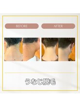 エクレ(EKURE)/男性うなじ脱毛