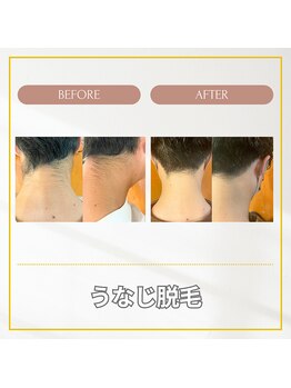 エクレ(EKURE)/男性うなじ脱毛