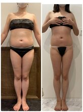 パリスヒロトン(PARIS HIROTON)/痩身症例写真(30代)