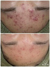 サロンドエタニティ ハピネス(salon de eternity)/ハーブピーリングでニキビ改善！