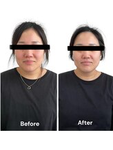 ブライトプラス(BRIGHT+)/ハイドロ毛穴洗浄+小顔ケア