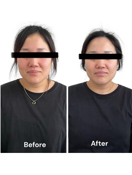 ブライトプラス(BRIGHT+)/ハイドロ毛穴洗浄+小顔ケア