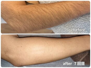 ノノケケ(NONOKEKE)/【メンズ脱毛】　パーツ脱毛(腕)