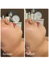 シーラックス(Sealax)/フェイスラインのもたつきにも◎