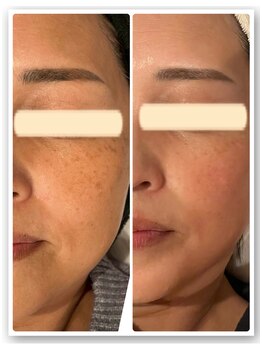 ママナ(mamana)/ホワイトラボ 1回での効果