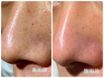 ミスター(Mr.)の写真/毛穴エクストラクションで黒ずみおさらば♪フェイシャルワックスで古い角質や産毛を優しく除去◎