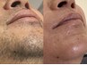 《男性限定》ヒゲWAX脱毛★青髭ケア◎ 60min