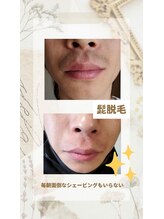 エピシア(EPISIA)/髭脱毛