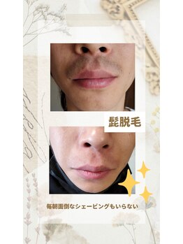 エピシア(EPISIA)/髭脱毛