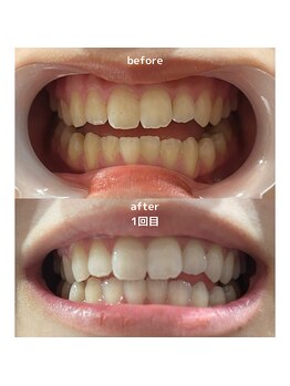 ワイズサロン(Y's salon)/ホワイトニング1回の症例です!