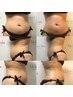 【ボディ】ダイエットに◎キャビテーションまたはラジオ波 ￥5,000 60分