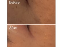 目元集中ケア★ビフォーアフターモニター価格あり