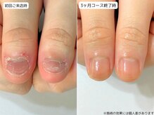 カピリナ(Ka Pilina)の雰囲気（深爪/平らな爪/噛み爪/爪は変わらないと諦めないでくださいね！）