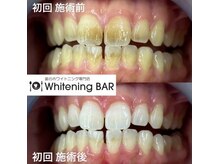 ホワイトニングバー 町田店/初回ビフォーアフターをご紹介