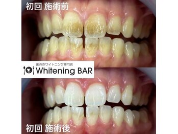 ホワイトニングバー 町田店/初回ビフォーアフターをご紹介