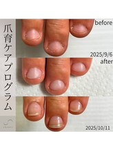 シュリ(shyuri)/深爪矯正